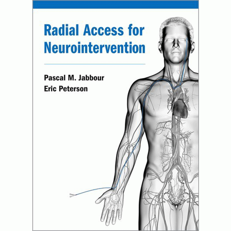 Radial Access for Neurointervention