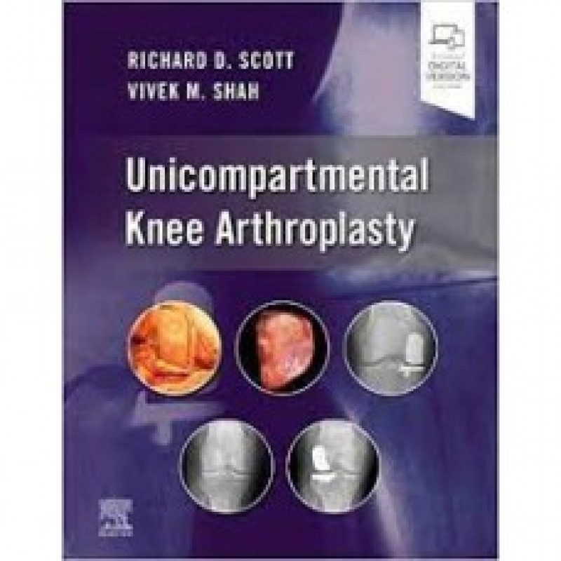 Unicompartmental Knee Arthroplasty