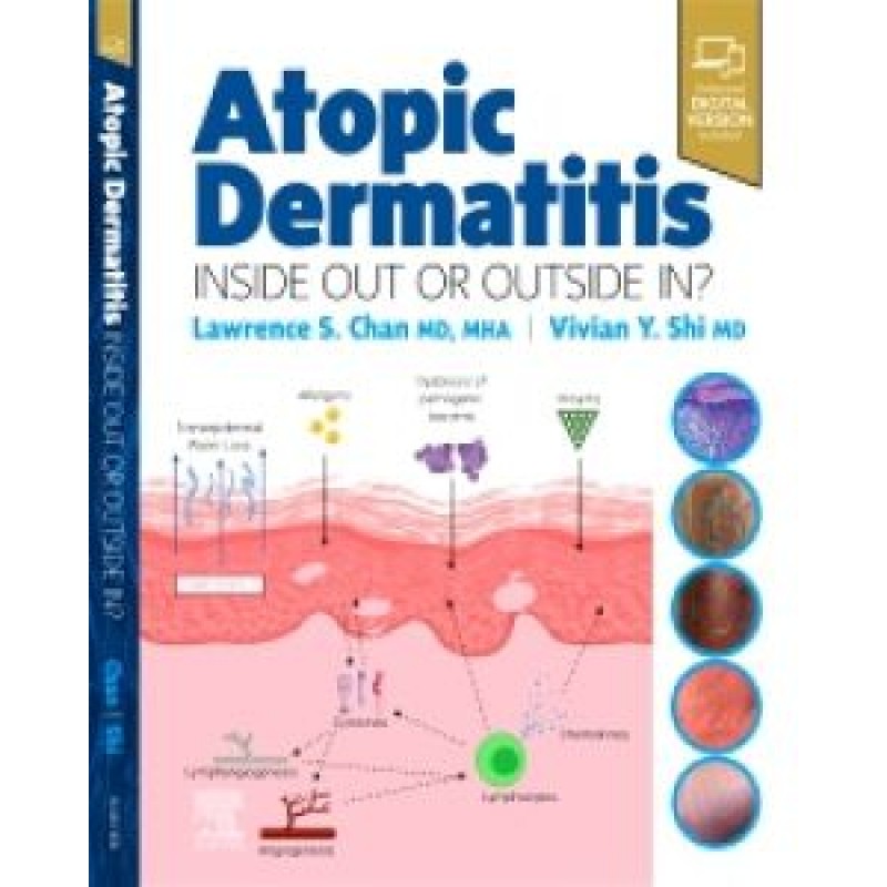 Atopic Dermatitis: Inside Out or Outside In 