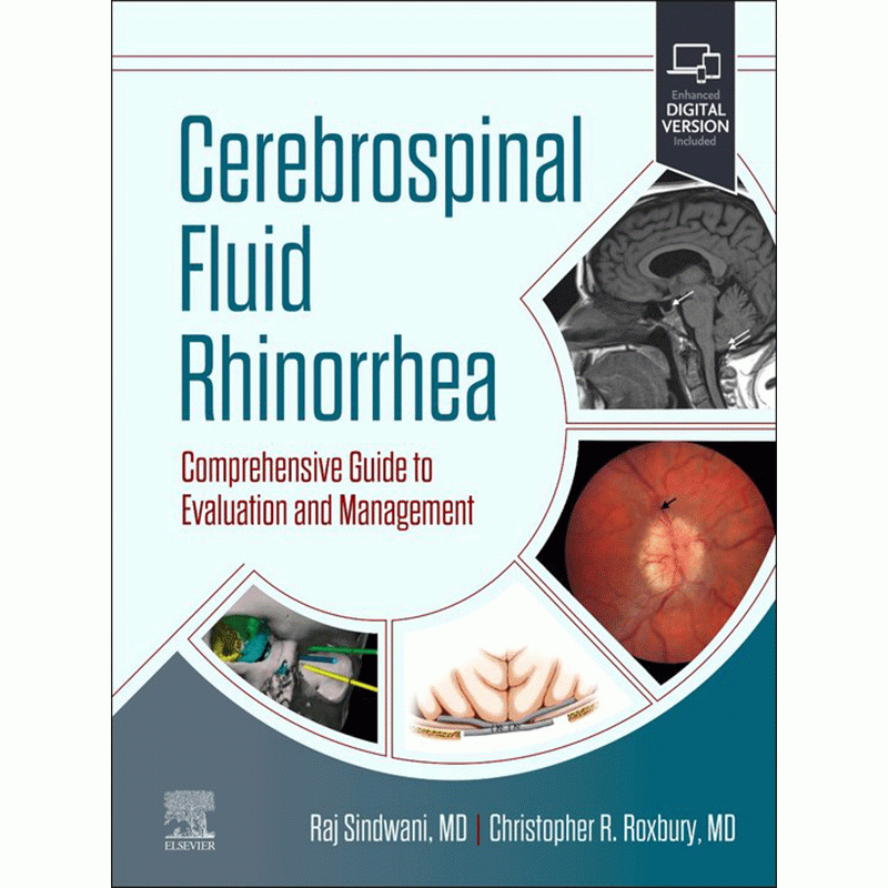 Cerebrospinal Fluid Rhinorrhea: Comprehensive Guide to Evaluation and Management