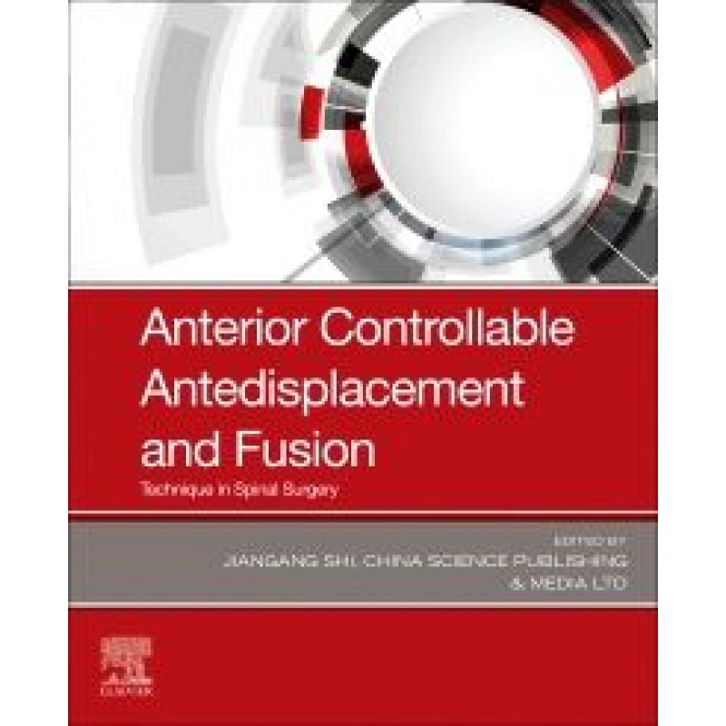 Anterior Controllable Antedisplacement and Fusion, 1st Edition