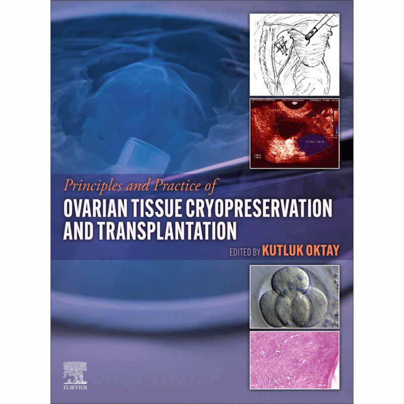 Principles and Practice of Ovarian Tissue Cryopreservation and Transplantation