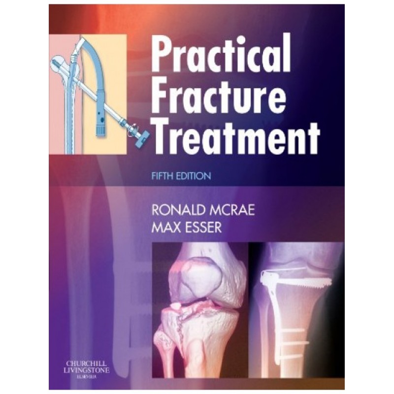 Practical Fracture Treatment by McRae, 5th Edition