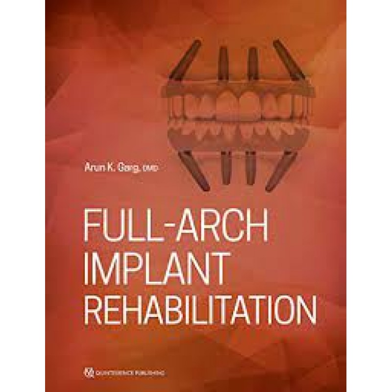 Full-Arch Implant Rehabilitation