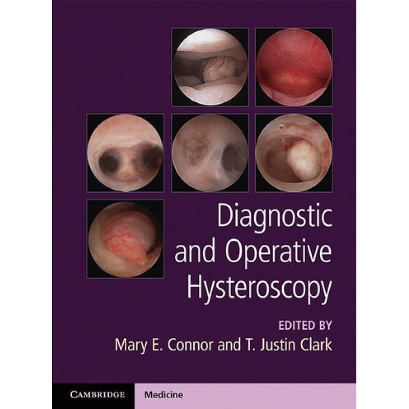 Diagnostic and Operative Hysteroscopy