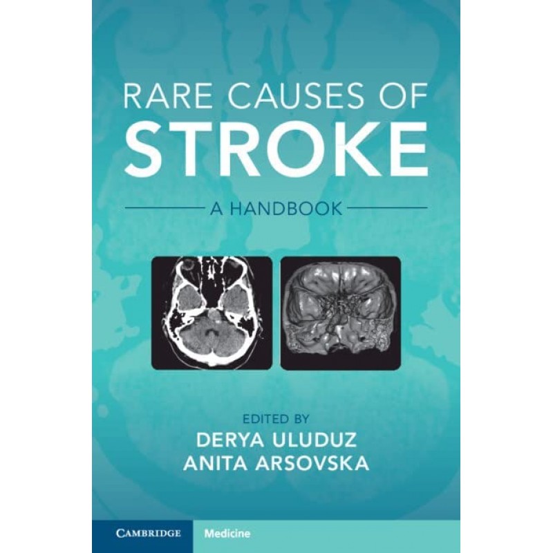 Rare Causes of Stroke A Handbook