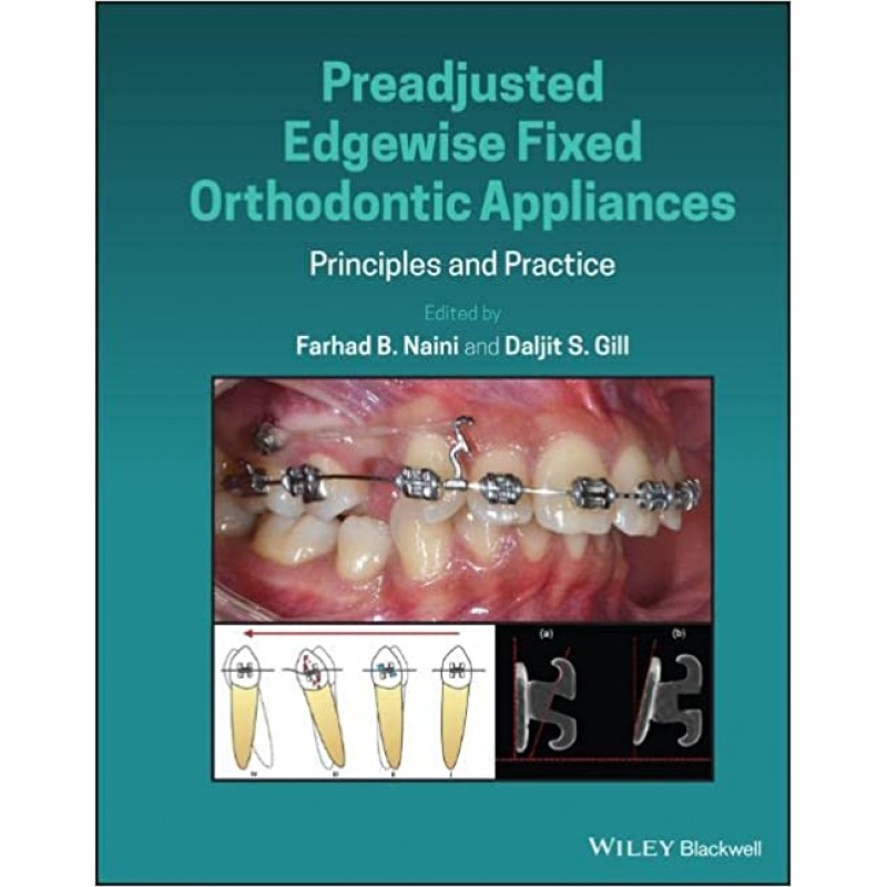 Preadjusted Edgewise Fixed Orthodontic Appliances: Principles and Practice