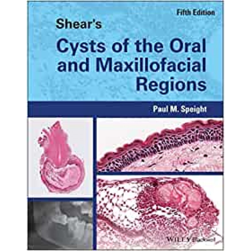 Shear's Cysts of the Oral and Maxillofacial Regions, 5E