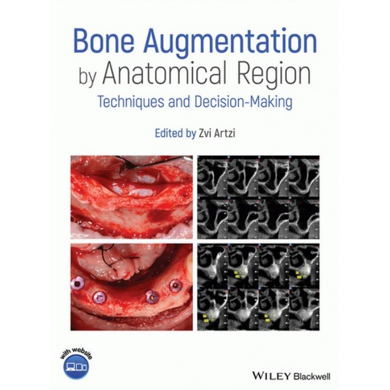 Bone Augmentation by Anatomical Region: Techniques and Decision-Making