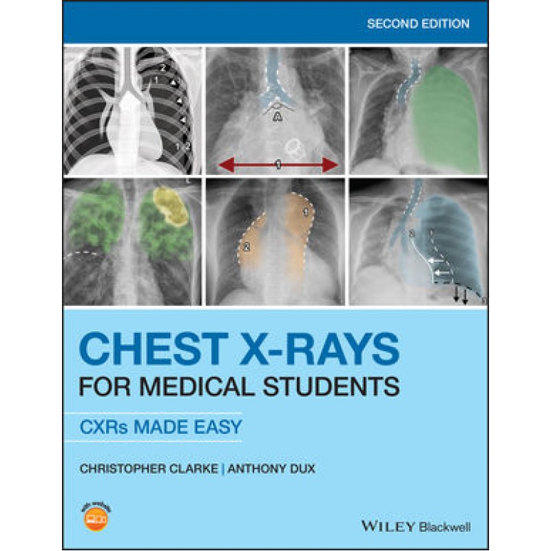 Chest X-Rays for Medical Students: CXRs Made Easy, 2nd Edition