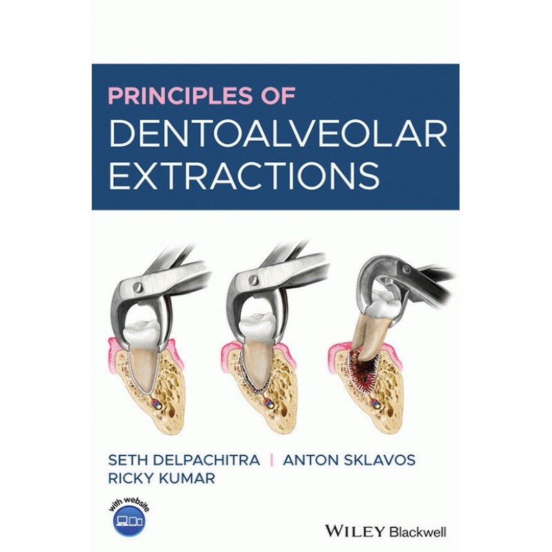 Principles of Dentoalveolar Extractions