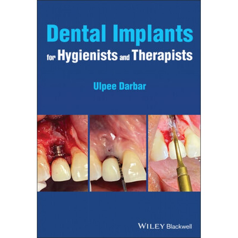 Dental Implants for Hygienists and Therapists