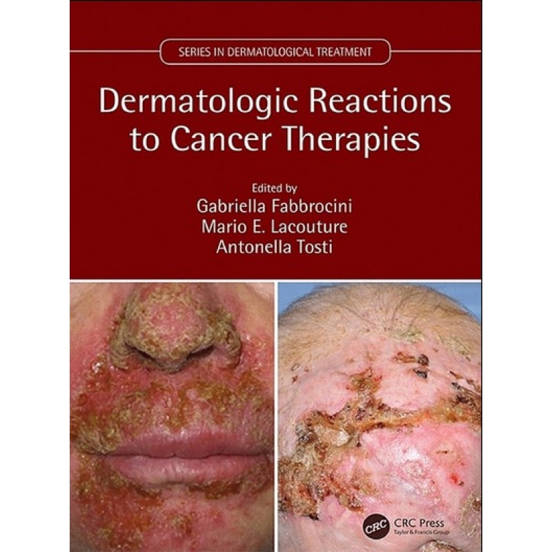 Dermatologic Reactions to Cancer Therapies 