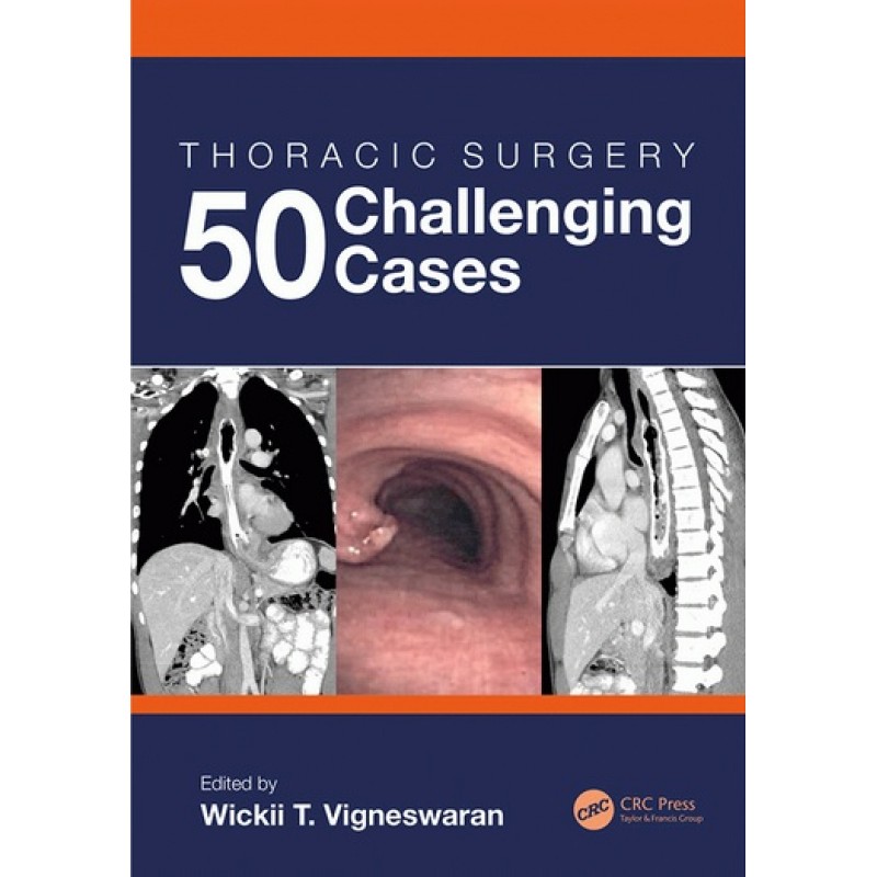 Thoracic Surgery: 50 Challenging cases 