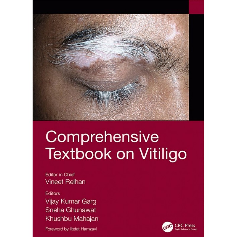 Comprehensive Textbook on Vitiligo