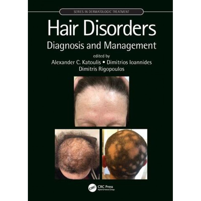 Hair Disorders Diagnosis and Management