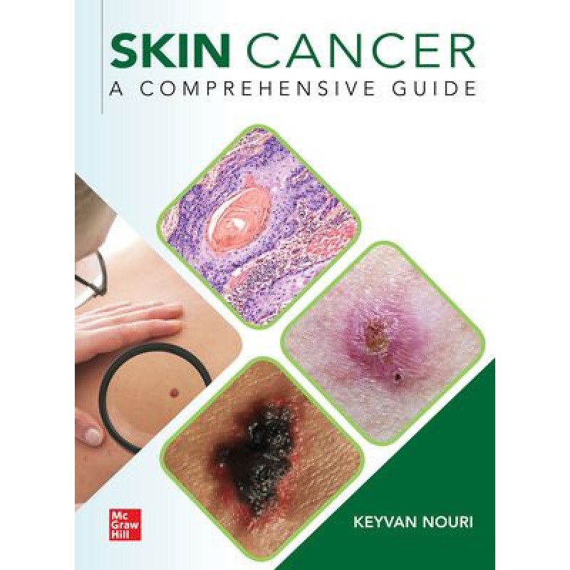 Skin Cancer: A Comprehensive Guide, 1st Edition