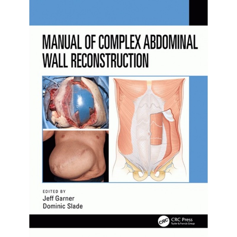 Manual of Complex Abdominal Wall Reconstruction 