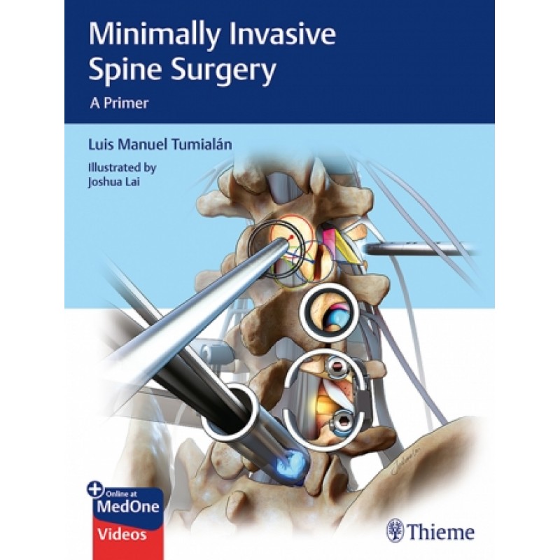 Minimally Invasive Spine Surgery 