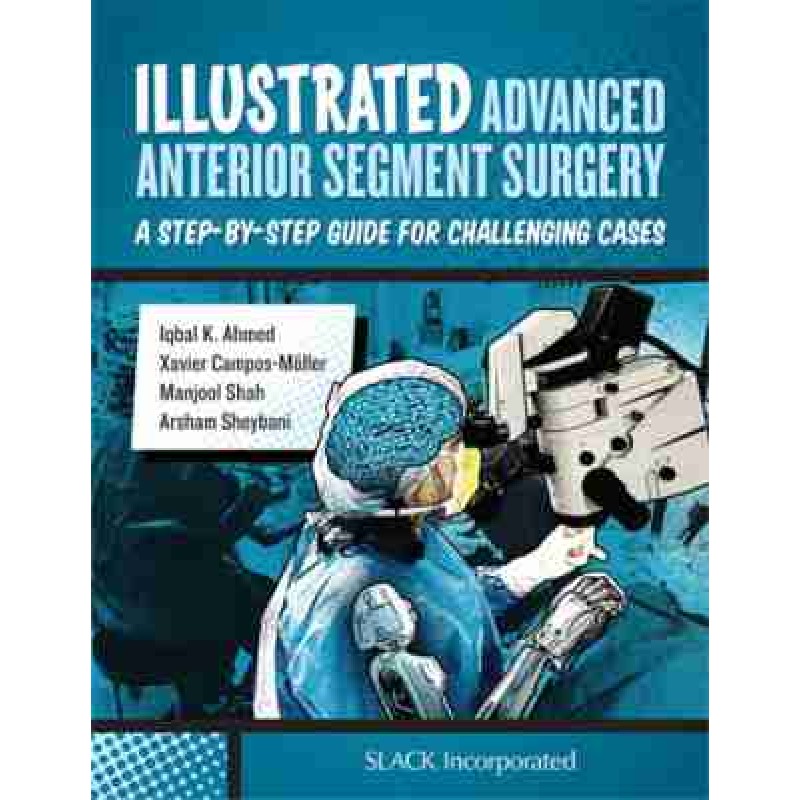 Illustrated Advanced Anterior Segment Surgery: A Step-by-Step Guide for Challenging Cases