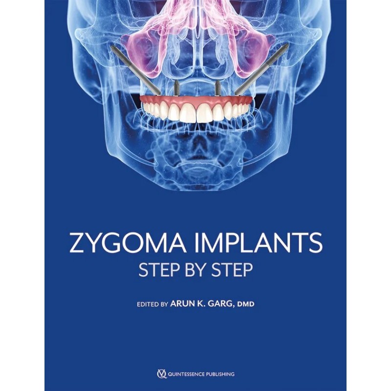 Zygoma Implants Step by Step, 1st Edition