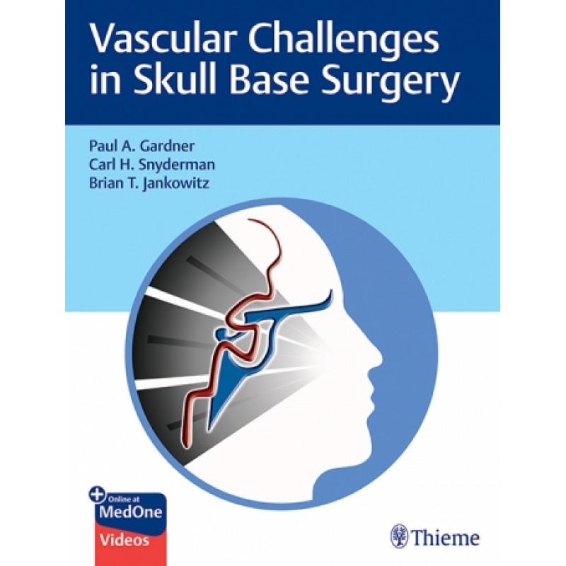 Vascular Challenges in Skull Base Surgery