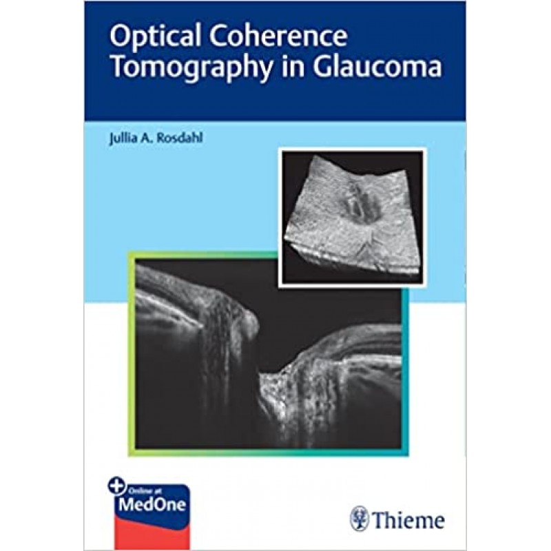 Optical Coherence Tomography in Glaucoma