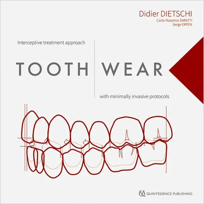 Tooth Wear: Interceptive treatment approach with minimally invasive protocols, 1st Edition