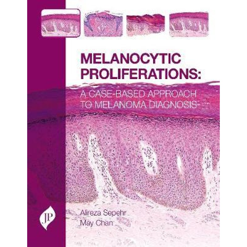 Melanocytic Proliferations