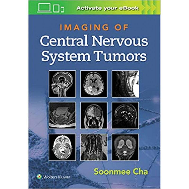 Imaging of Central Nervous System Tumors First edition