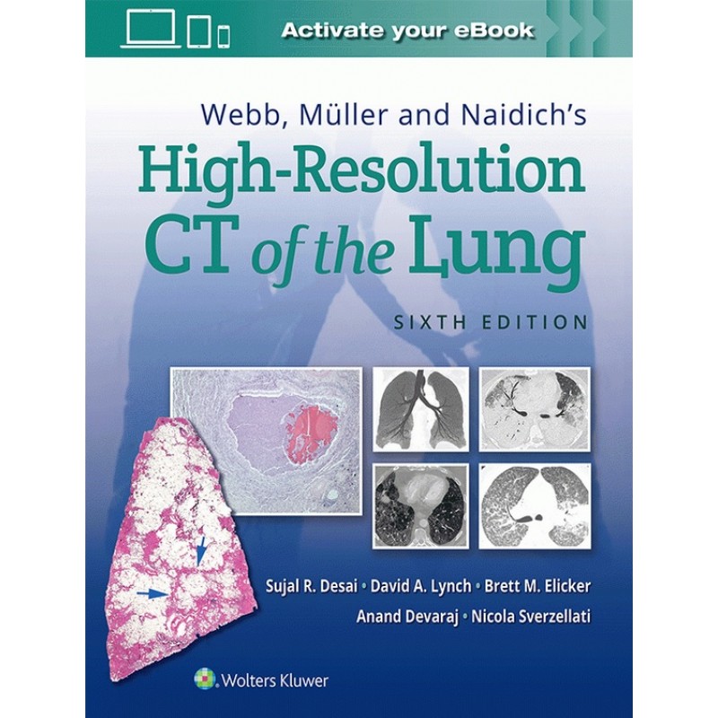 Webb, Müller and Naidich's High-Resolution CT of the Lung 6E