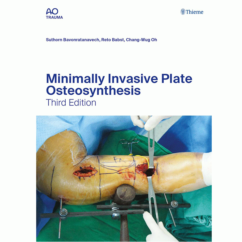 Minimally Invasive Plate Osteosynthesis, 3rd Edition