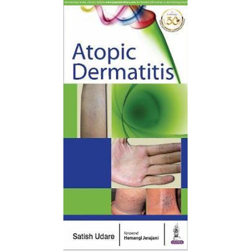  Atopic Dermatitis