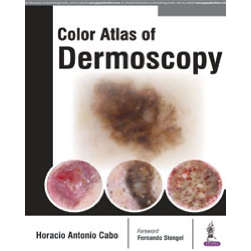  Color Atlas of Dermoscopy