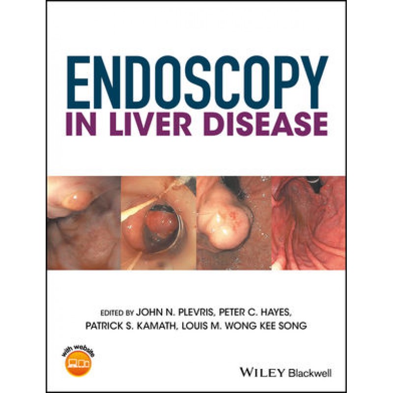 Endoscopy in Liver Disease