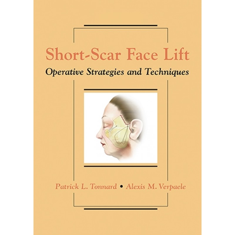  Short-Scar Face Lift Operative Strategies and Techniques