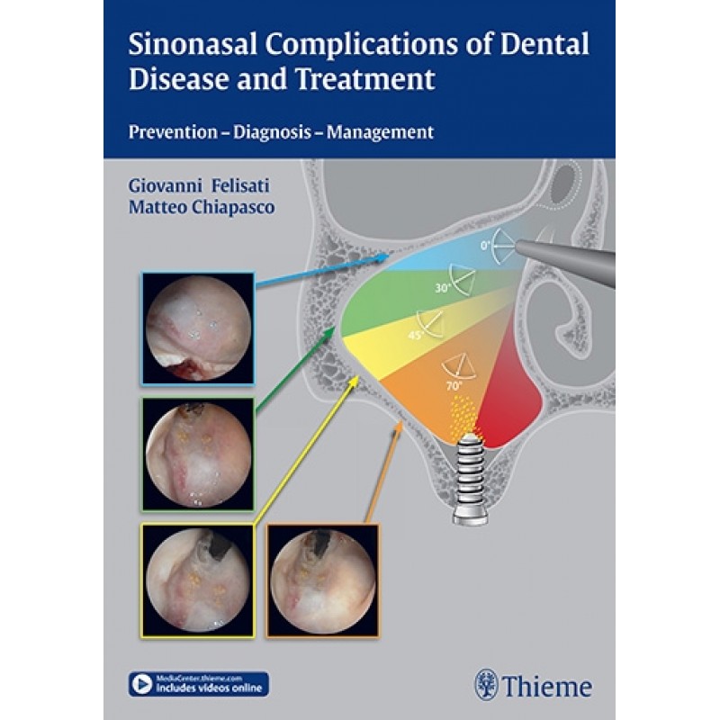 Sinonasal Complications of Dental Disease and Treatment Prevention - Diagnosis - Management