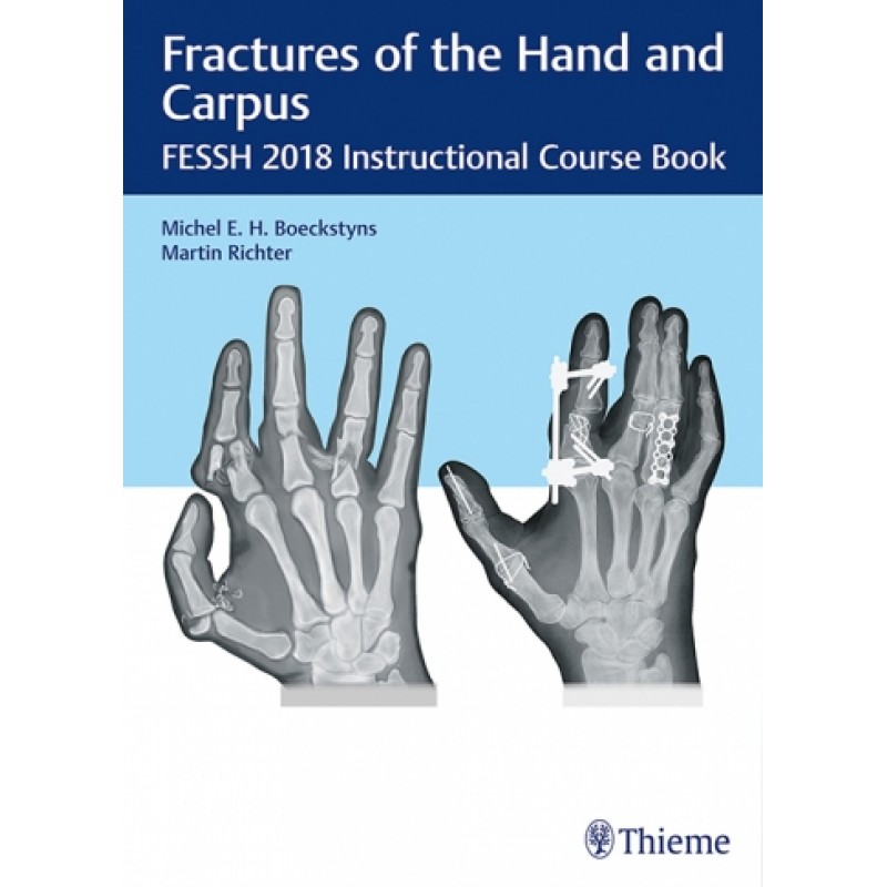 Fractures of the Hand and Carpus FESSH 2018 Instructional Course Book