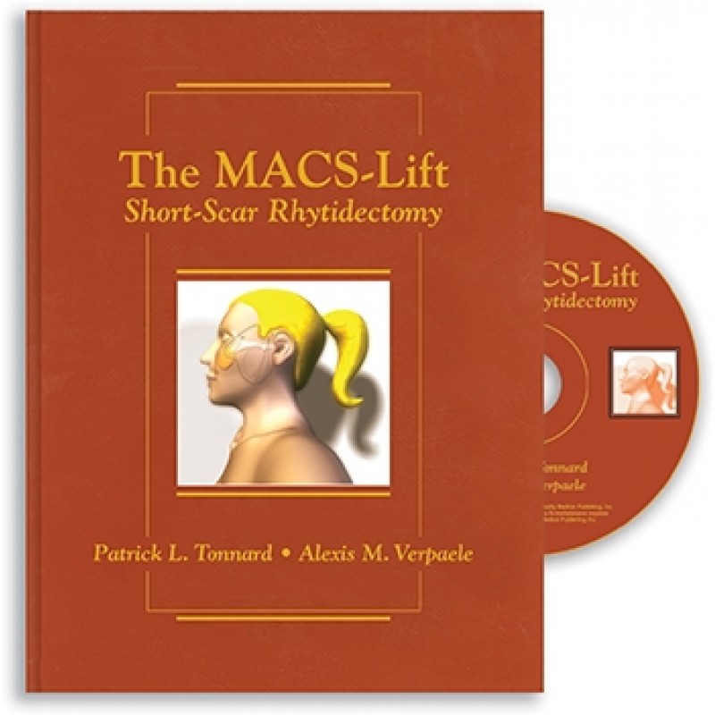 The MACS-Lift Short-Scar Rhytidectomy