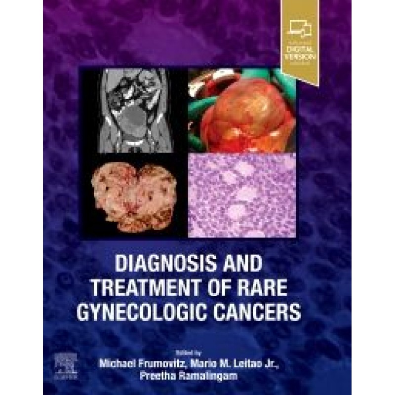 Diagnosis and Treatment of Rare Gynecologic Cancers