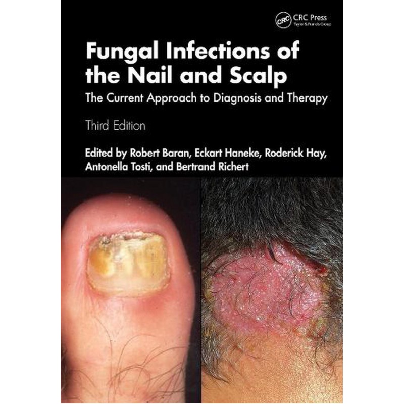 Fungal Infections of the Nail and Scalp. The Current Approach to Diagnosis and Therapy 3rd Edition