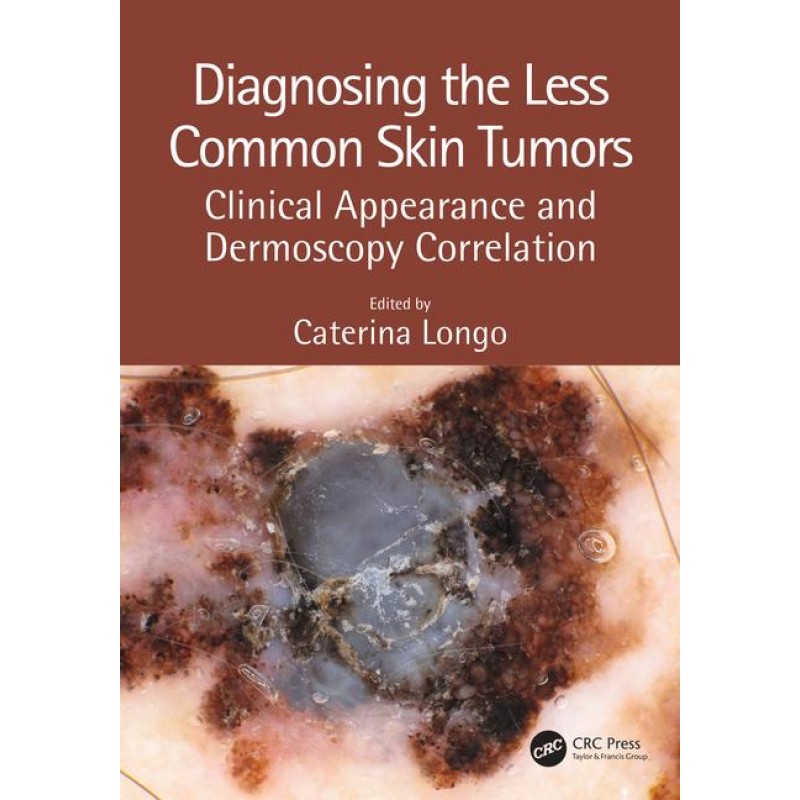 Diagnosing the Less Common Skin Tumors: Clinical Appearance and Dermoscopy Correlation