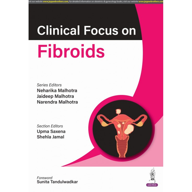 Clinical Focus on Fibroids