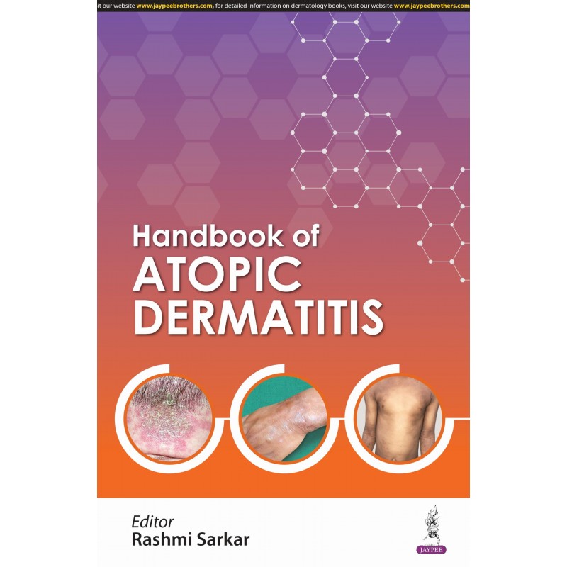 Handbook of Atopic Dermatitis