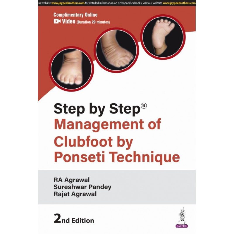 Step by Step: Management of Clubfoot by Ponseti Technique