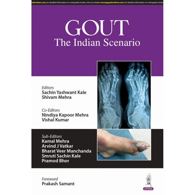 Gout: The Indian Scenario