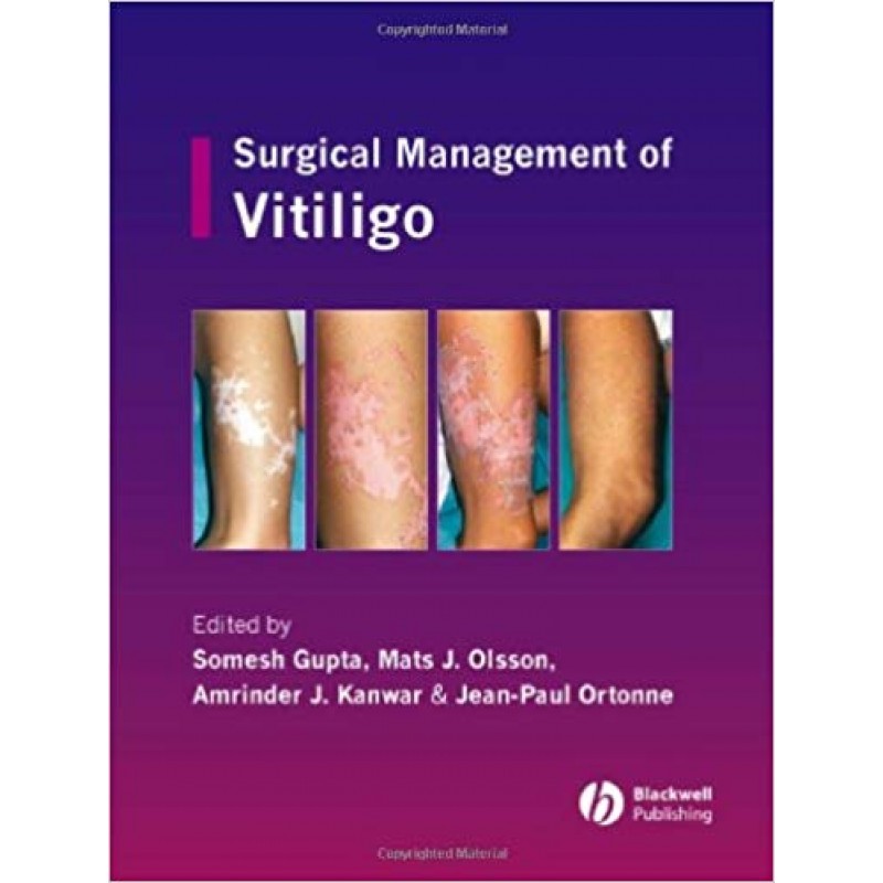 Surgical Management of Vitiligo