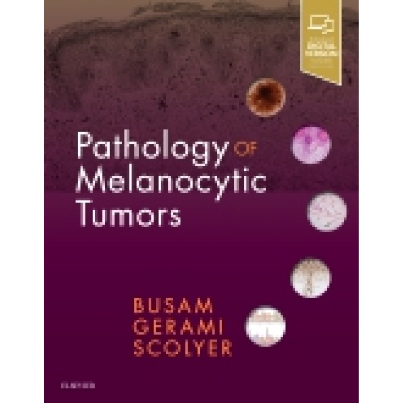 Pathology of Melanocytic Tumors