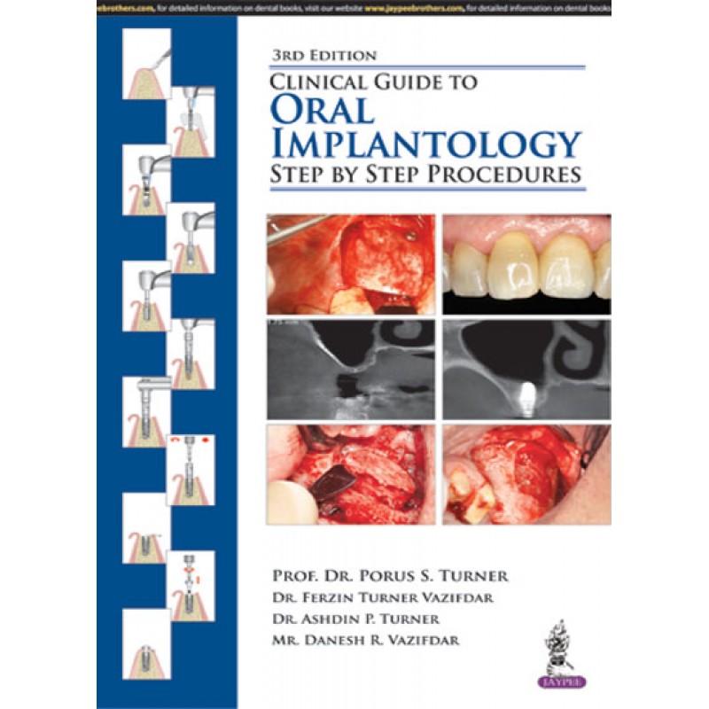 Clinical Guide to Oral Implantology: Step by Step Procedures