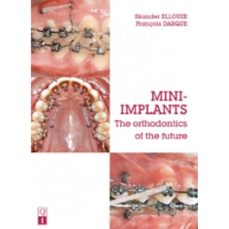 Mini-Implants The orthodontics of the future